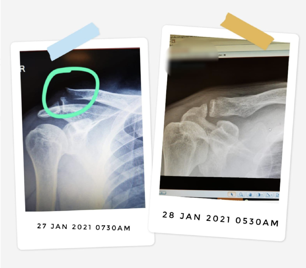 X-rays showing Danny's broken collar bone: Broken on the day of the accident (left) and healed less than 24 hours later (right).