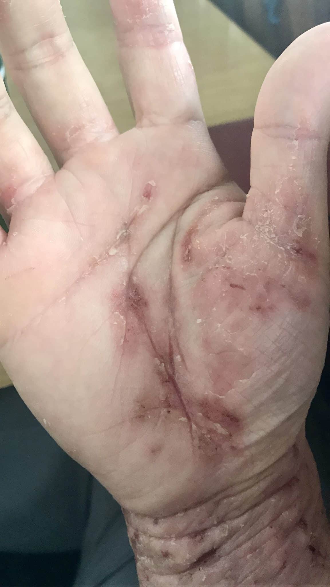 eczema
