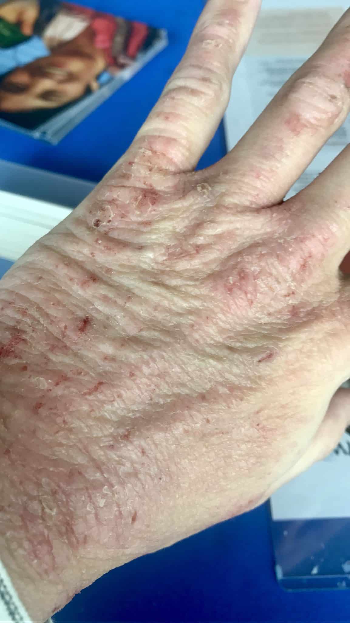 eczema