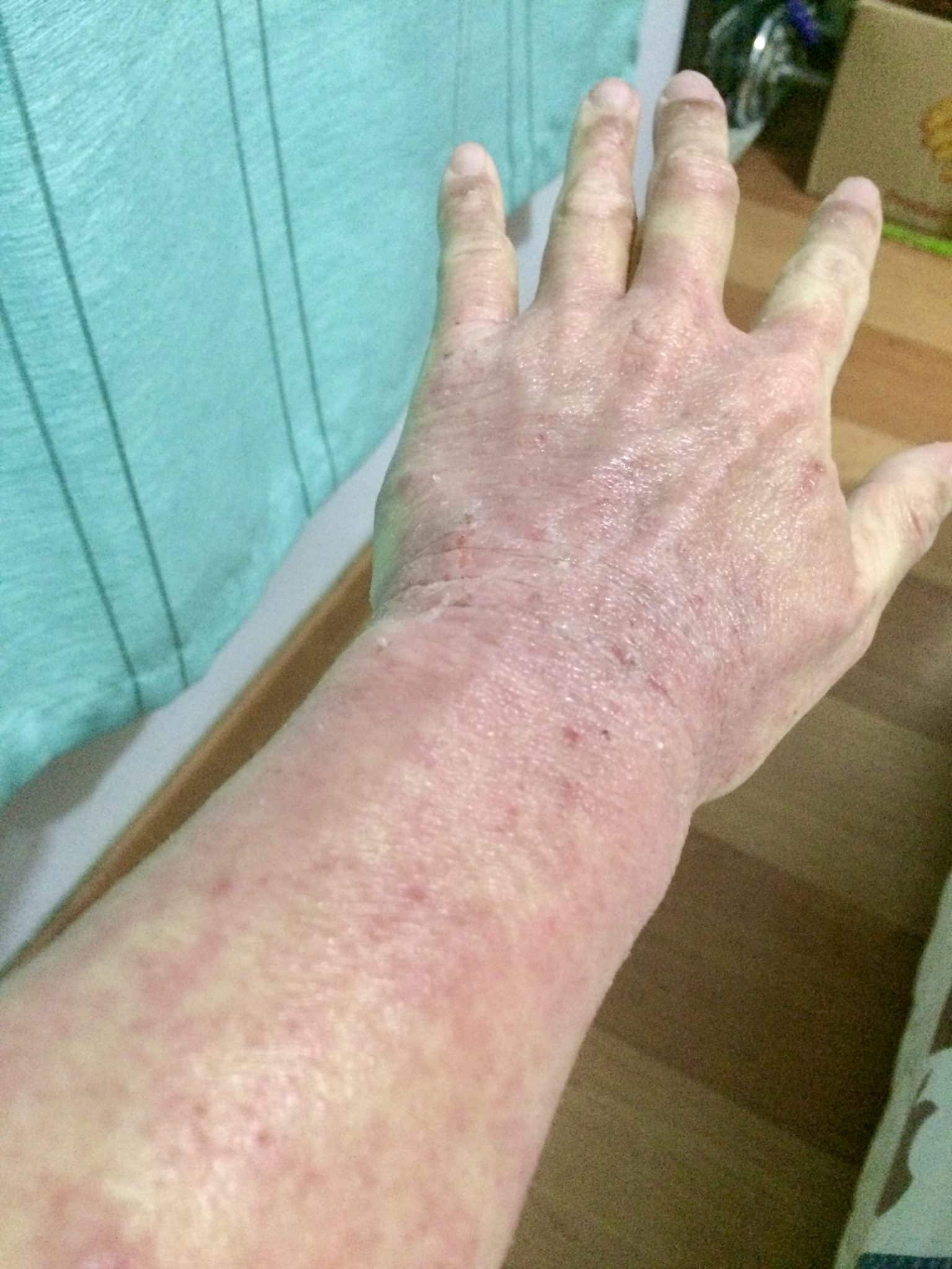 eczema